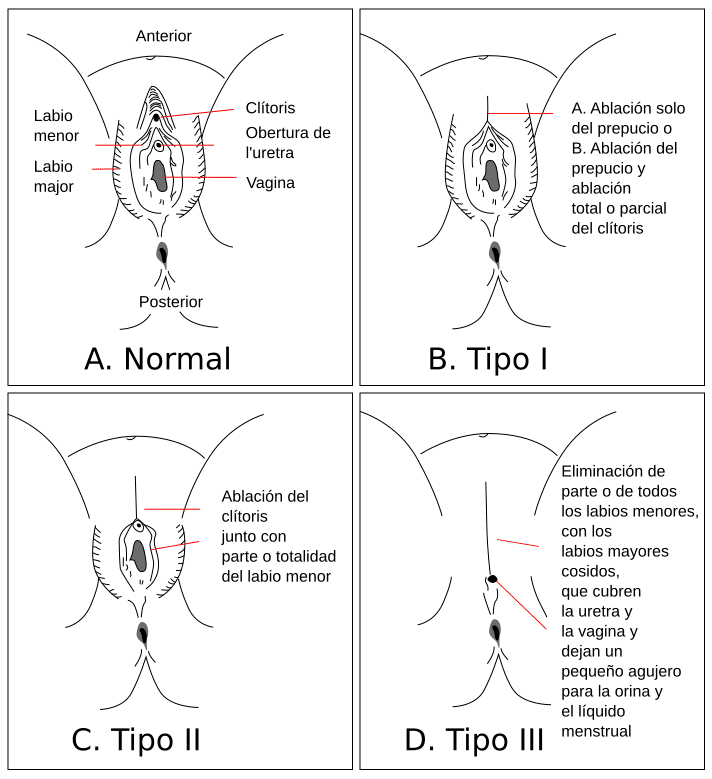 Tipos de Mutilación Genital Femenina